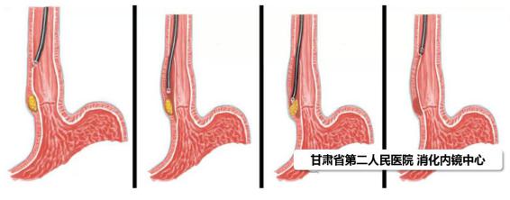 甘肃省第二人民医院消化科开展ster术切除食管危险部位固有肌层病变