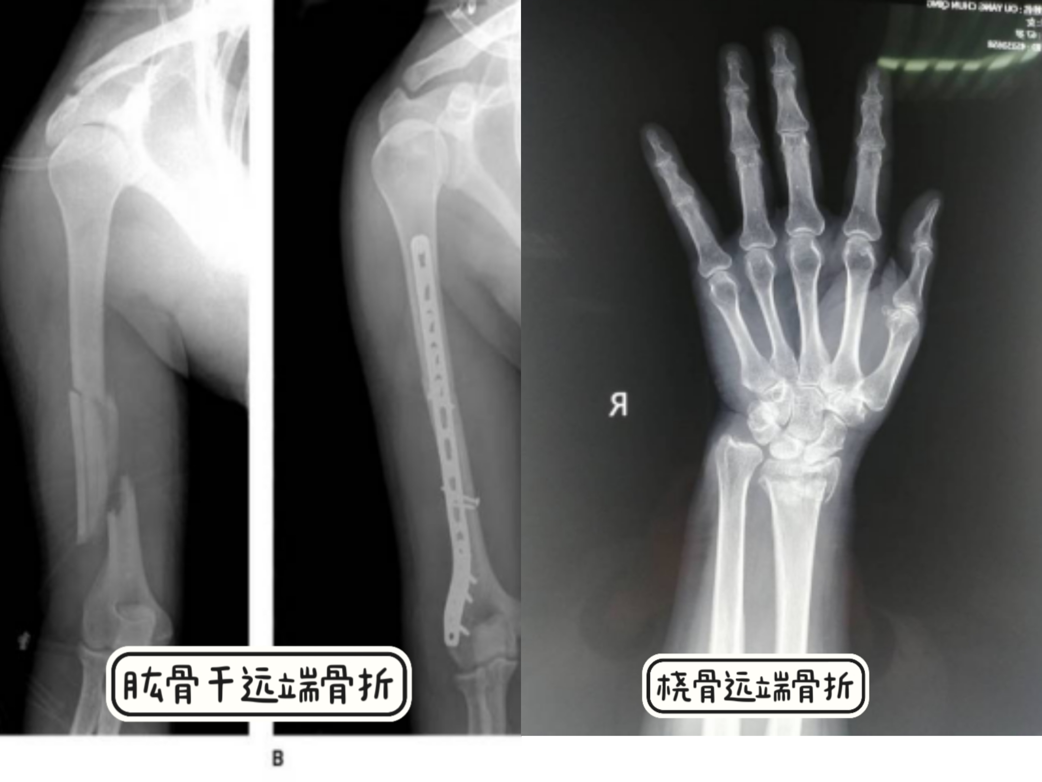 应急科普丨冰雪天路防滑防摔，且听骨科大夫支招-医疗常识-甘肃省第二